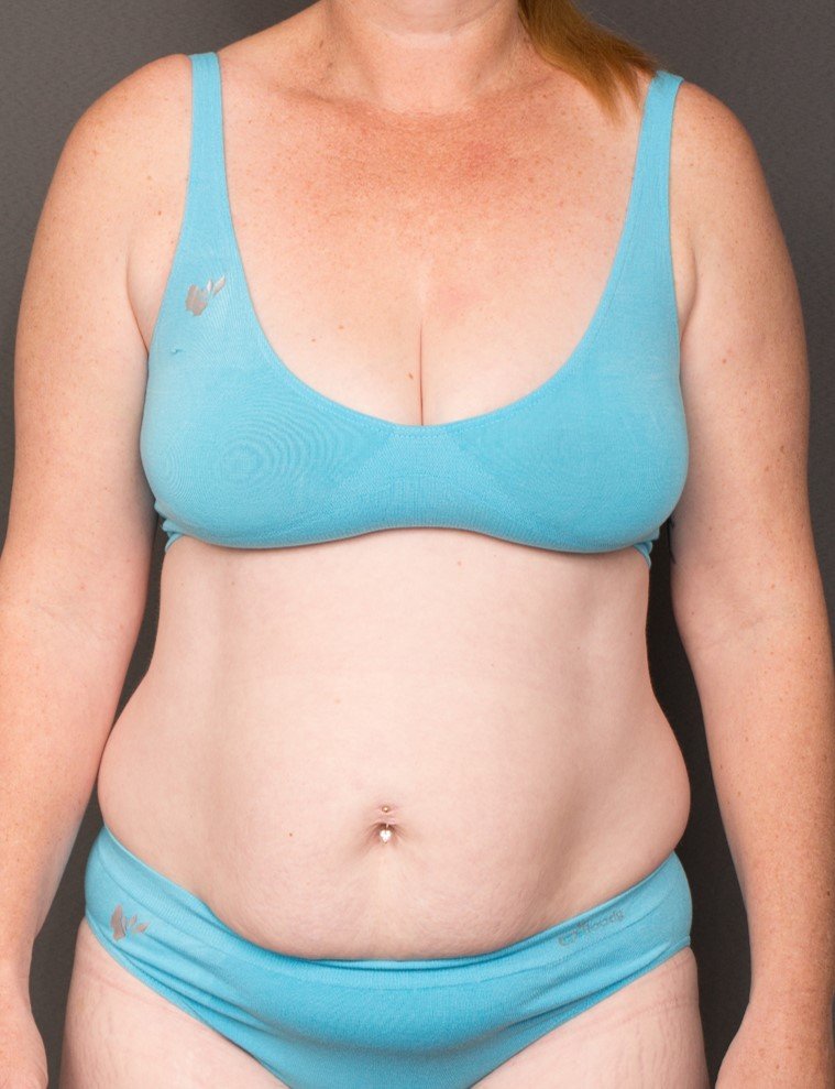38yo Abdominoplasty Dr Gavin Sandercoe