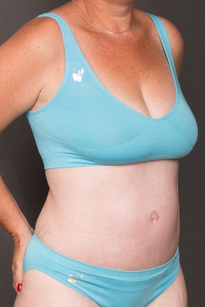 38yo Abdominoplasty Dr Gavin Sandercoe