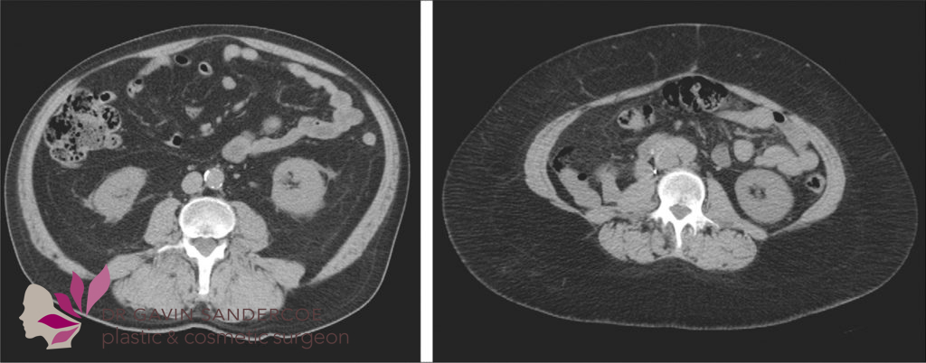 CT scans showing abdominal fat positions