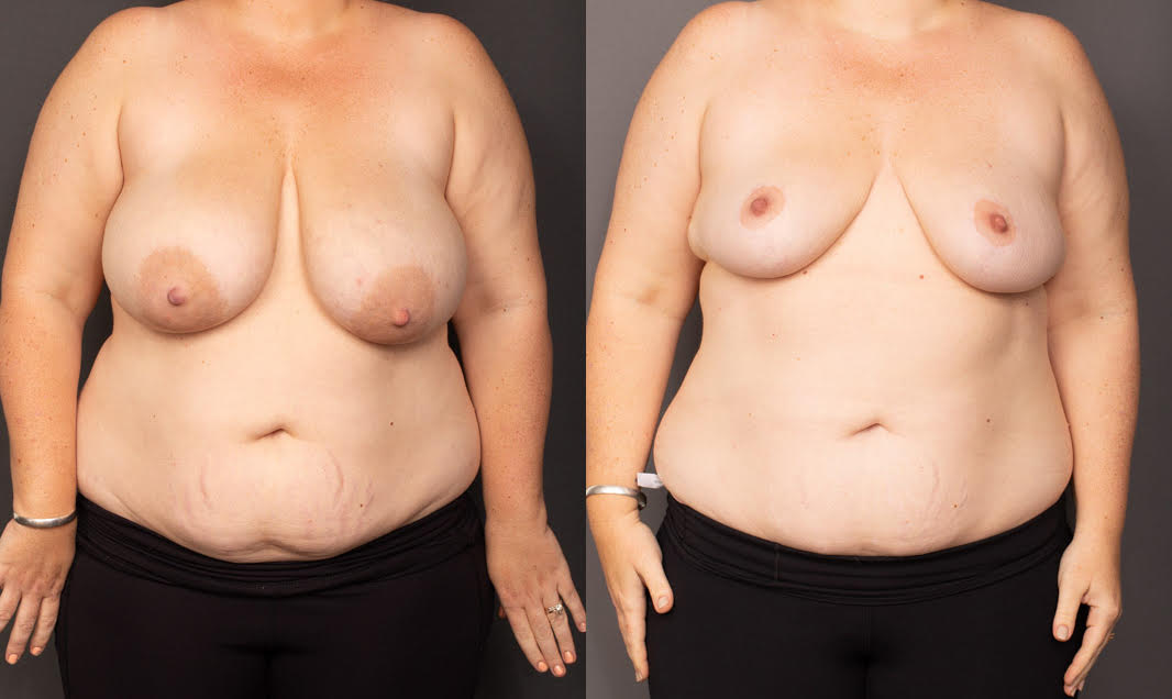 Before my breast reduction surgery I was…