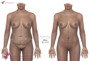 No dog ears after abdominoplasty with 3:1 ratio