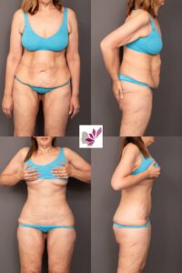 Dr Gavin Sandercoe Abdominoplasty Consecutive Result 10 - Corset with umbilical loss