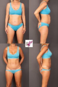Dr Gavin Sandercoe Abdominoplasty Consecutive Result 9