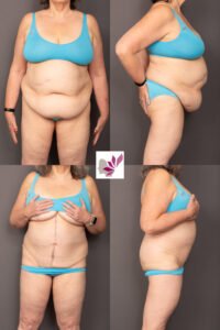 Dr Gavin Sandercoe Abdominoplasty Consecutive Result 8 - Hypertrophic corset scar