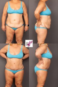Dr Gavin Sandercoe Abdominoplasty Consecutive Result 7