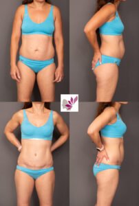 Dr Gavin Sandercoe Abdominoplasty Consecutive Result 6