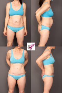 Dr Gavin Sandercoe Abdominoplasty Consecutive Result 5