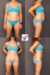 Dr Gavin Sandercoe Abdominoplasty Consecutive Result 4