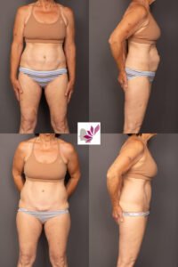 Dr Gavin Sandercoe Abdominoplasty Consecutive Result 2