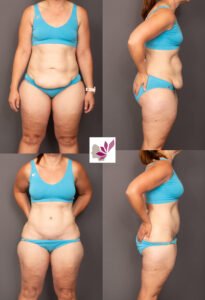 Dr Gavin Sandercoe Abdominoplasty Consecutive Result 1